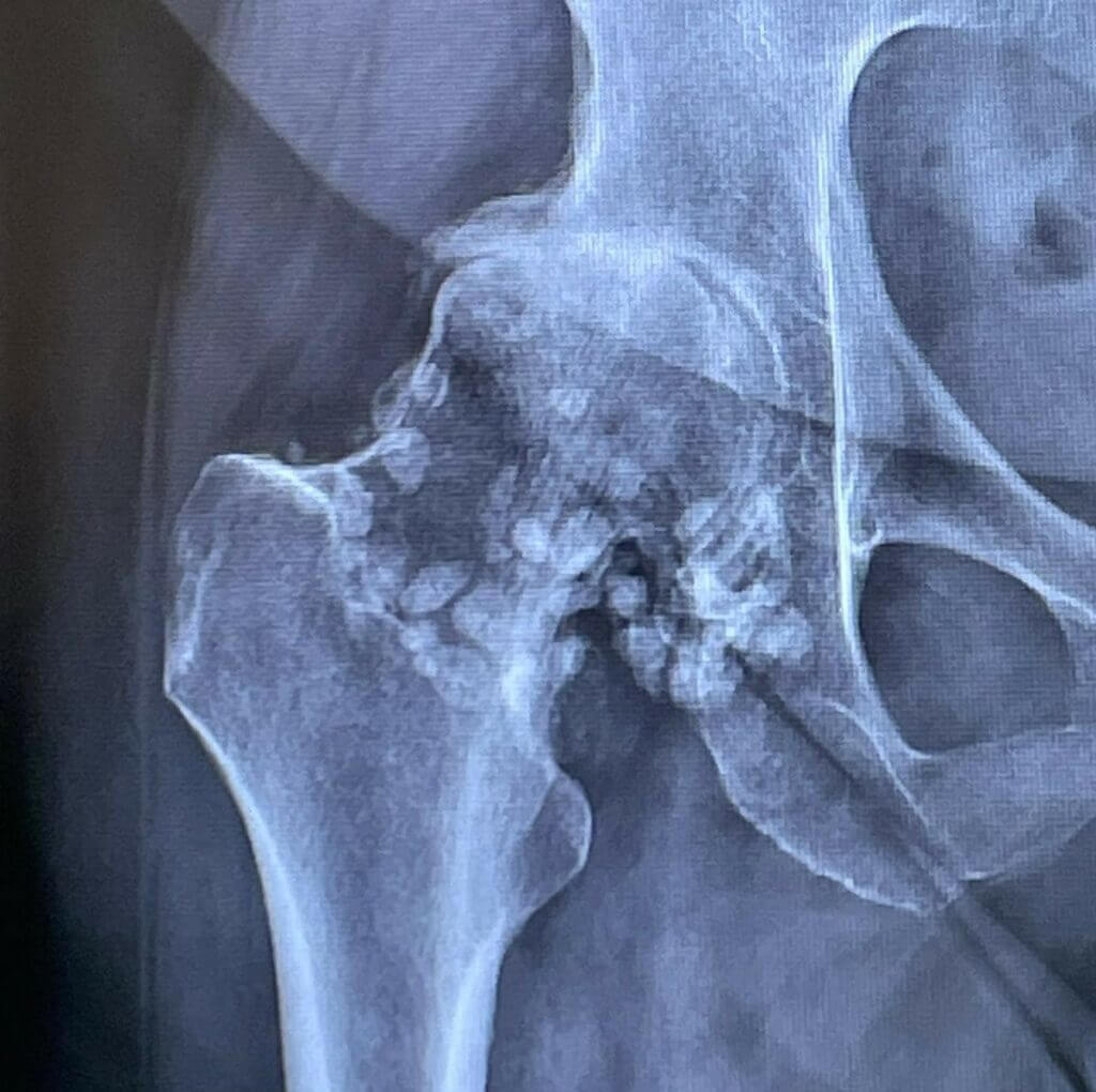 Röntgenbild einer Hüfte
