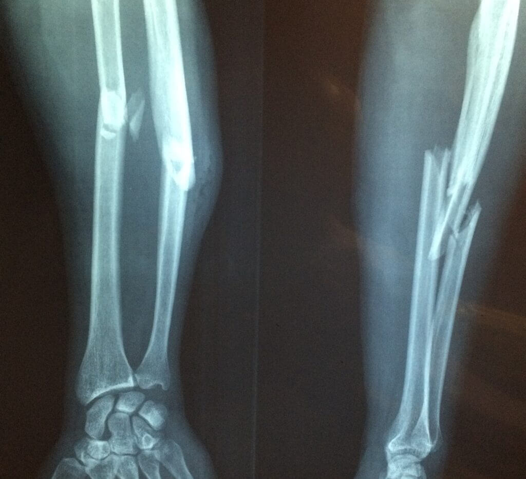 Zwei Röntgenbilder eines gebrochenen Unterarms