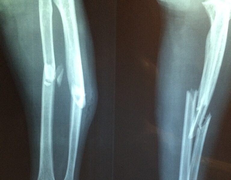 Zwei Röntgenbilder eines gebrochenen Arms